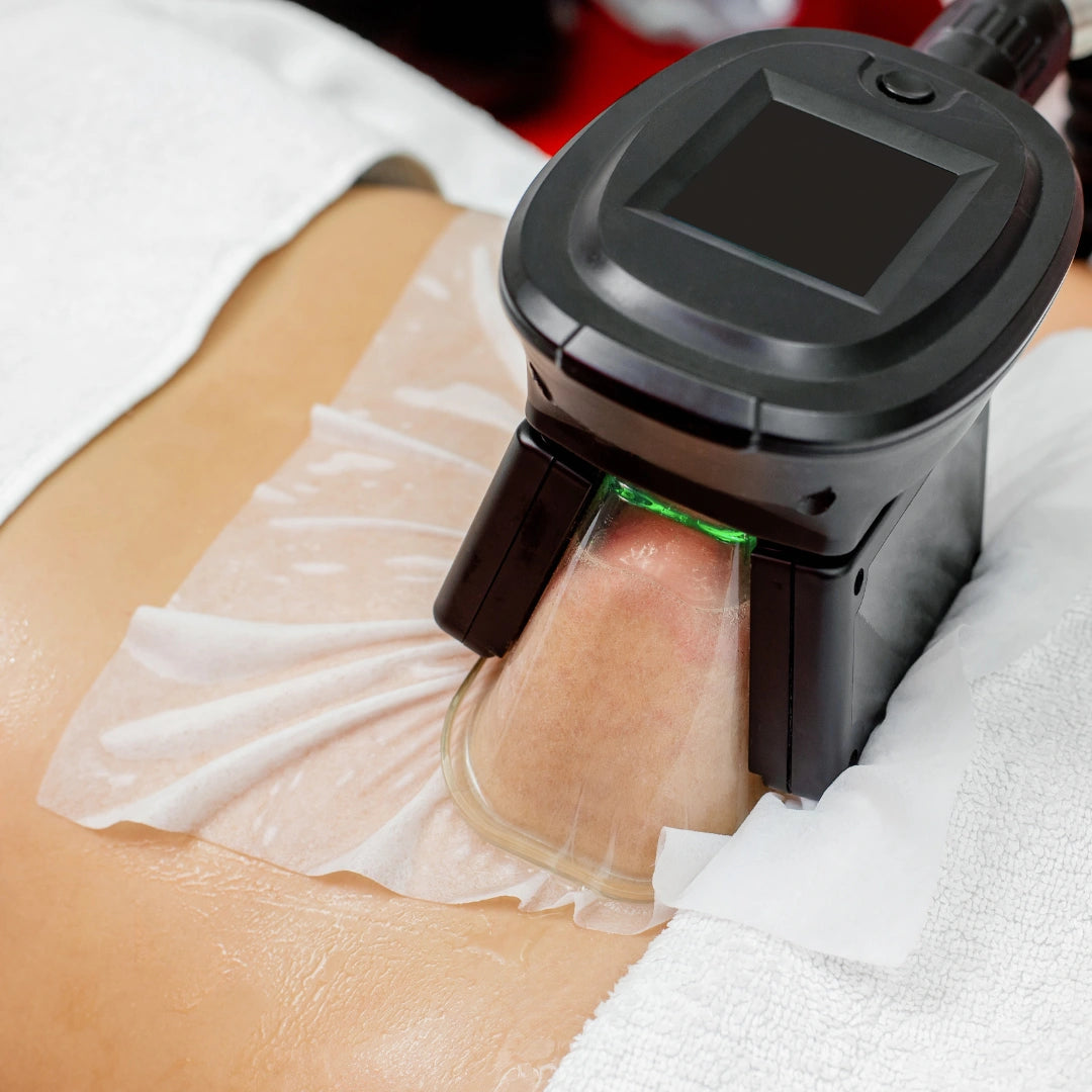 Criolipolisis Brazos