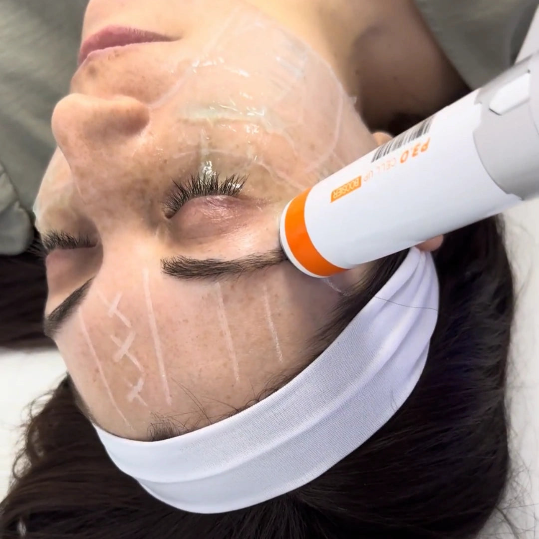 Elimina-patas-de-gallo