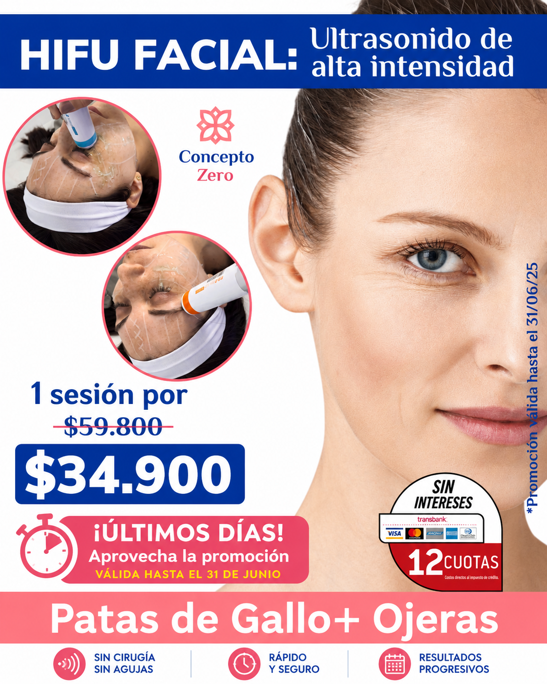 HIFU 12D Patas de Gallo + Ojeras | 1 Sesión $34.900