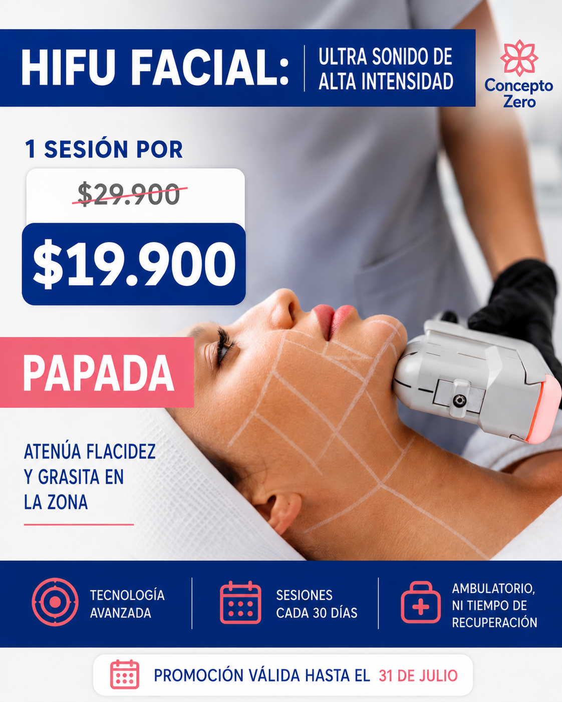 HIFU 12D Papada