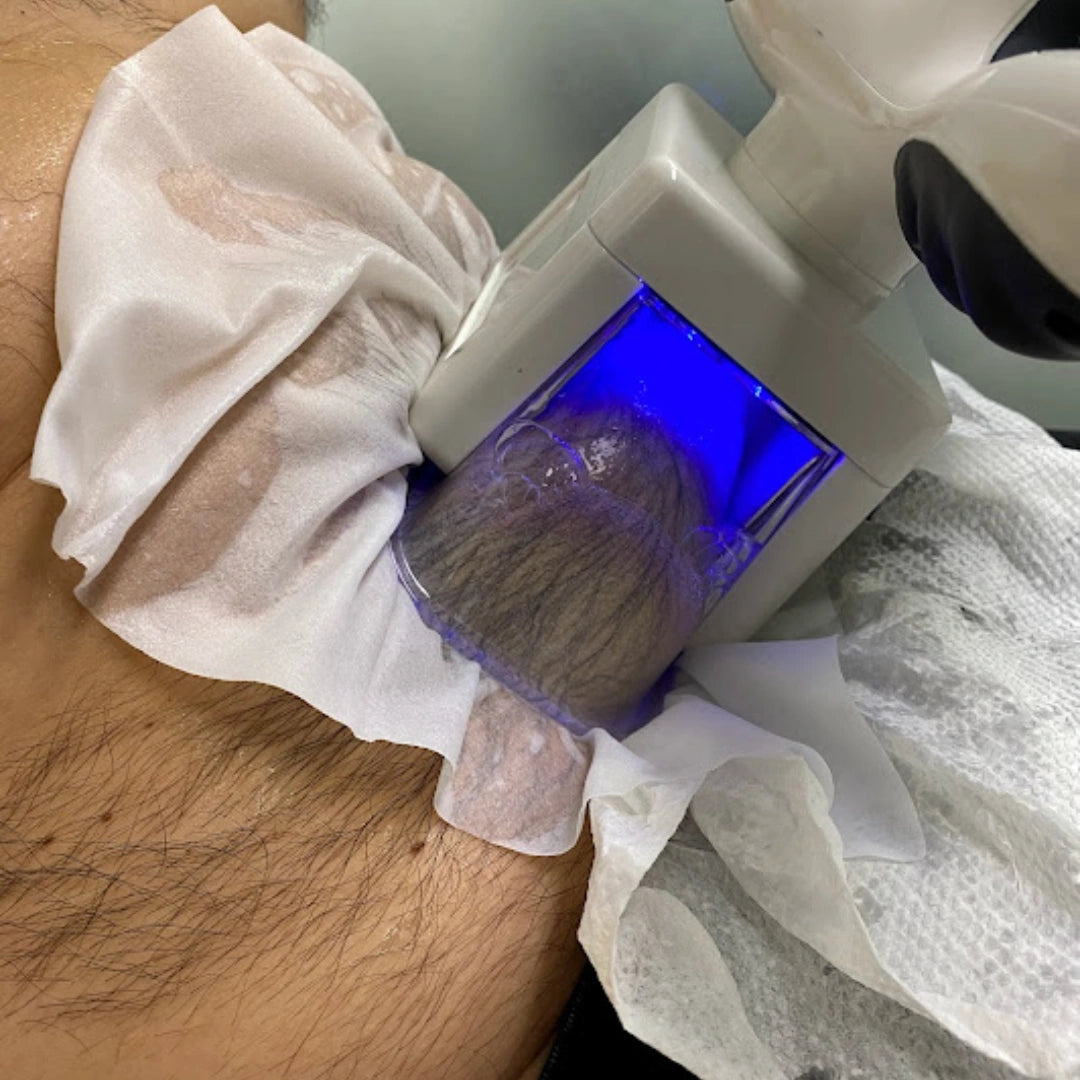 Criolipolisis Abdomen Bajo