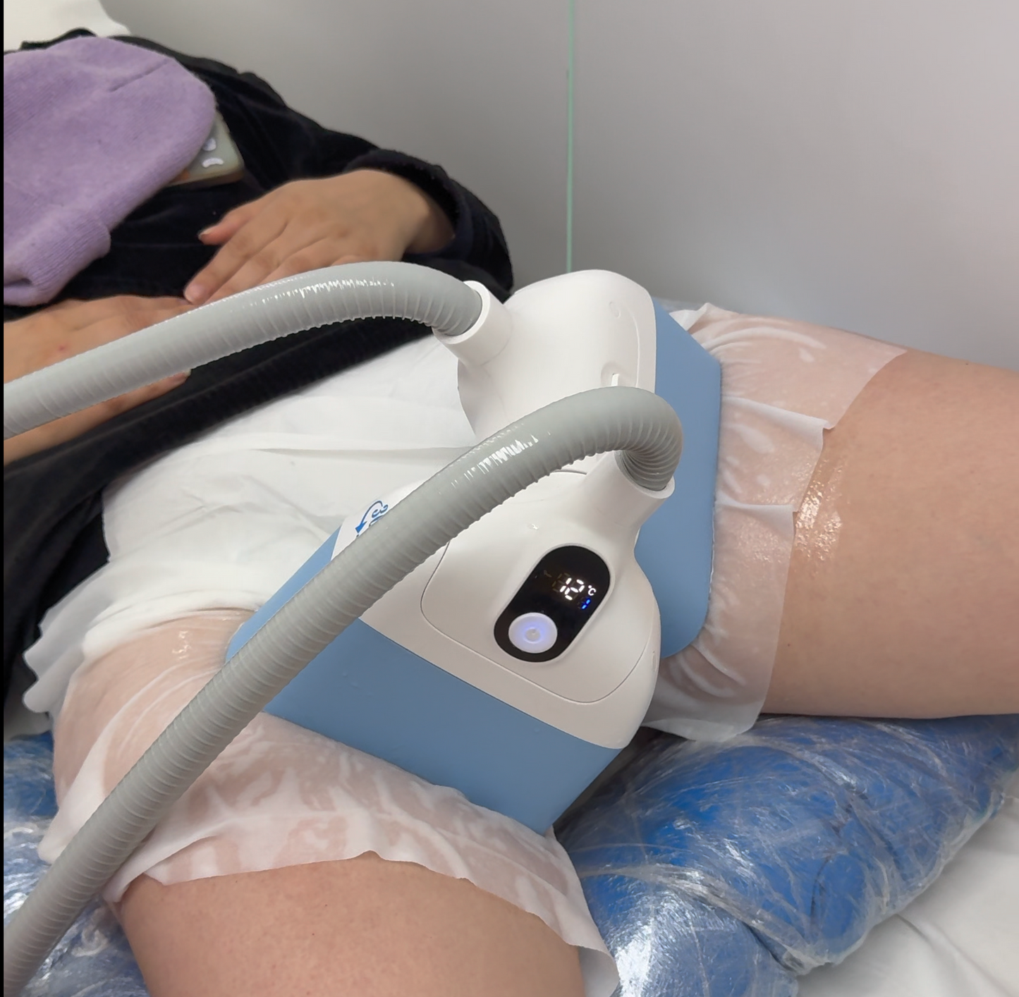 Criolipolisis Entrepiernas