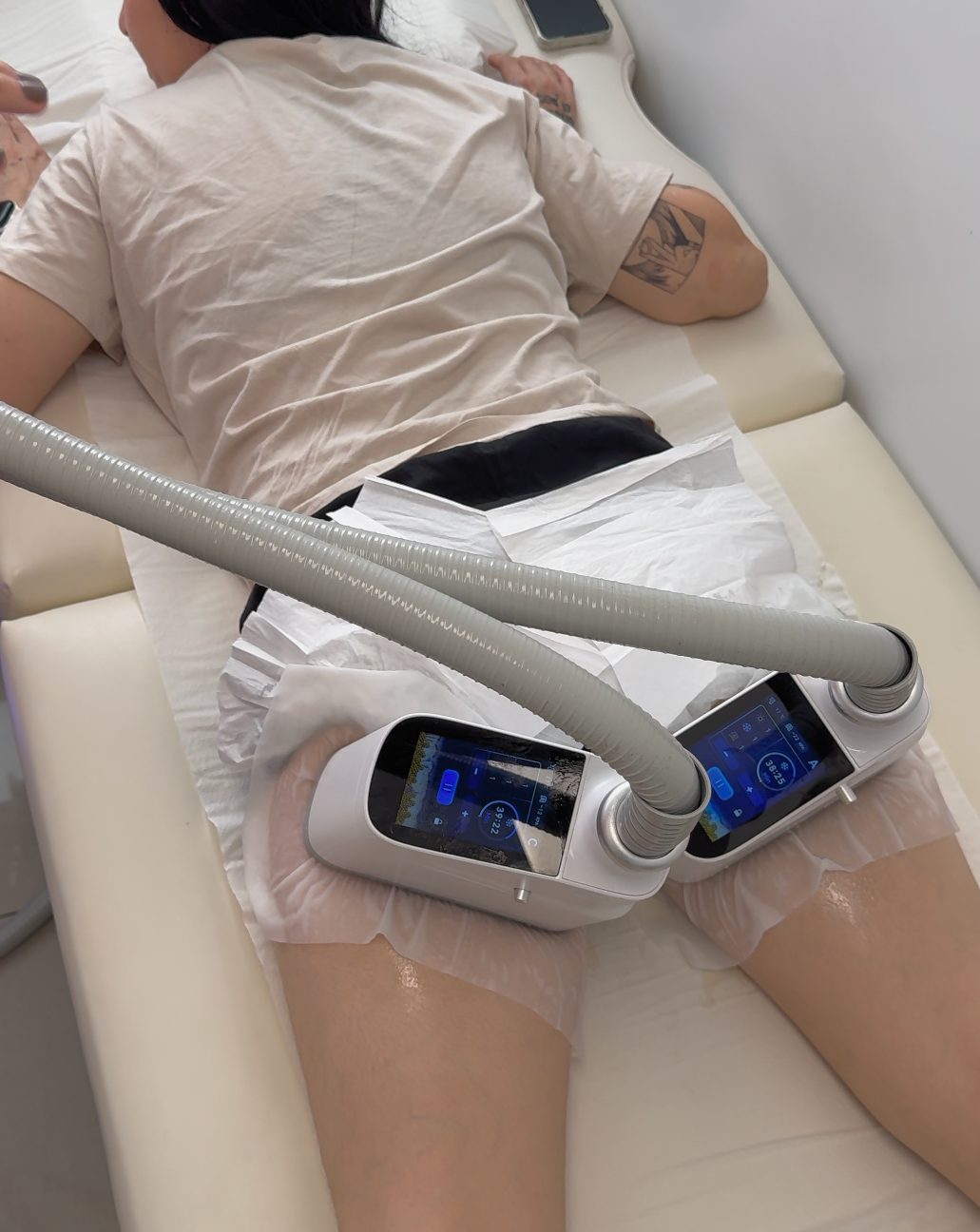 Criolipolisis Subgluteos